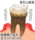 歯ぐきが歯を支えられなくなり、グラグラしている状態