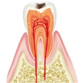 C1(軽度の虫歯)