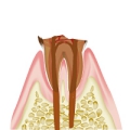 C4(歯の根まで侵食)