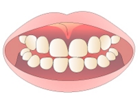 歯ぐきの黒ずみ除去