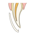 付け爪のような状態に作製されたセラミックを貼りつけます
