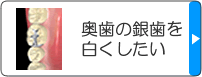 奥歯の銀歯を白くしたい