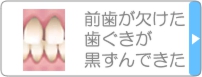 前歯が欠けた・歯ぐきが黒ずんできた