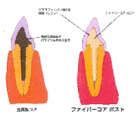 ファイバーコアポスト
